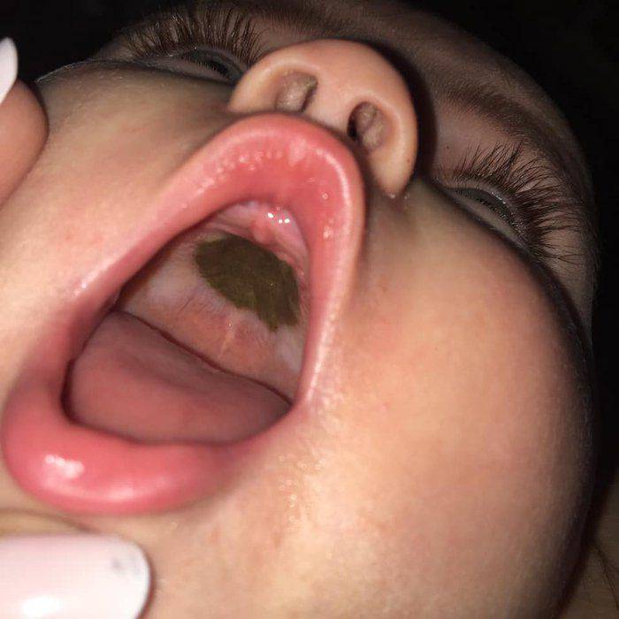 bambina con macchia strana in bocca