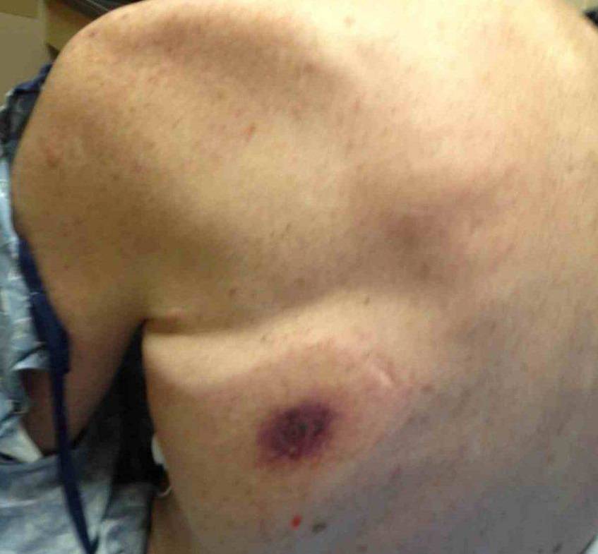 fascite necrotizzante