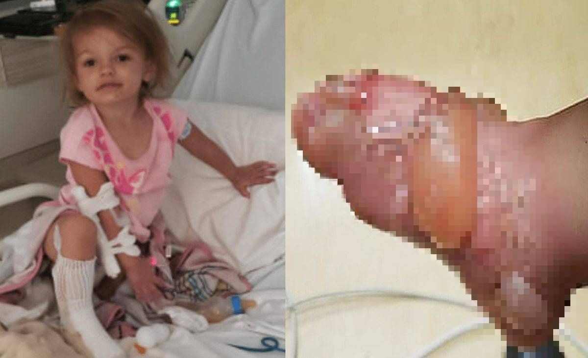 Bambina di due anni con gravi ustioni