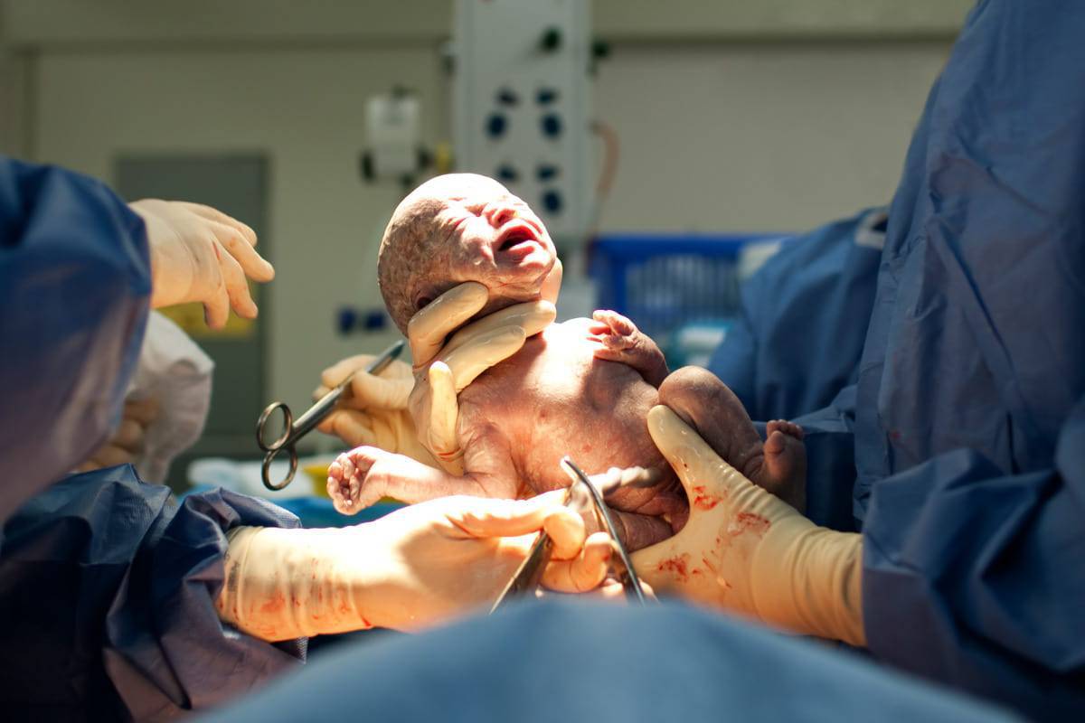 bambini nati con il cesareo