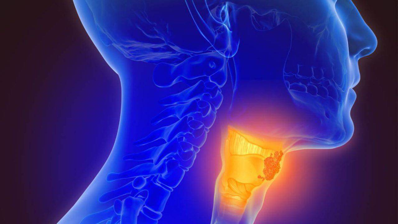 papilloma virus cancro gola toxoplasma pozitiva in sarcina