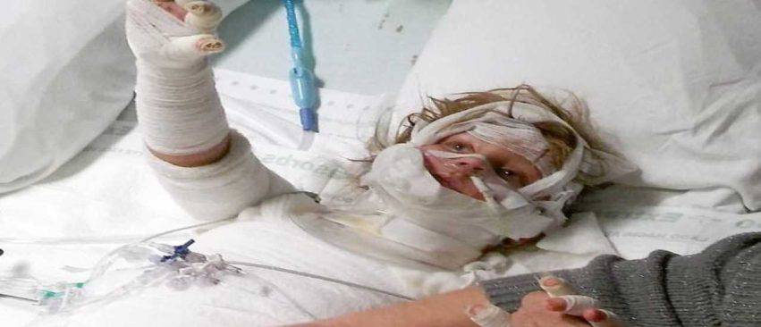 bambina ustionata con una candela
