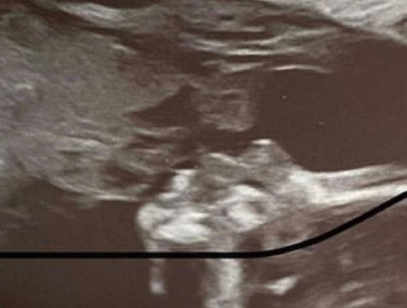 mamma volto ecografia