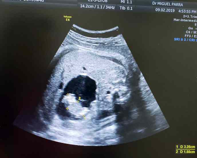 neonata nasce incinta 12