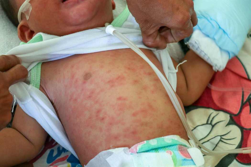 Epidemia di morbillo bambini