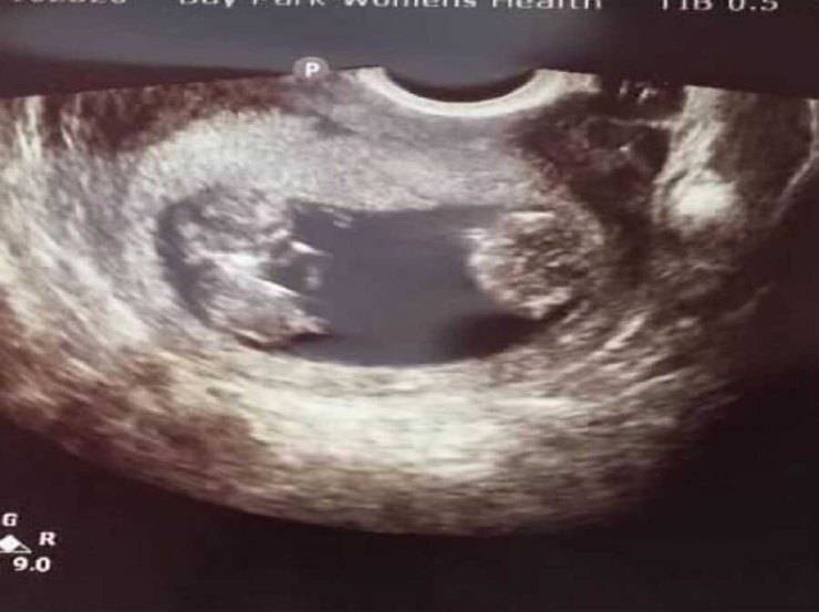 incinta di gemelli consiglio abortirne