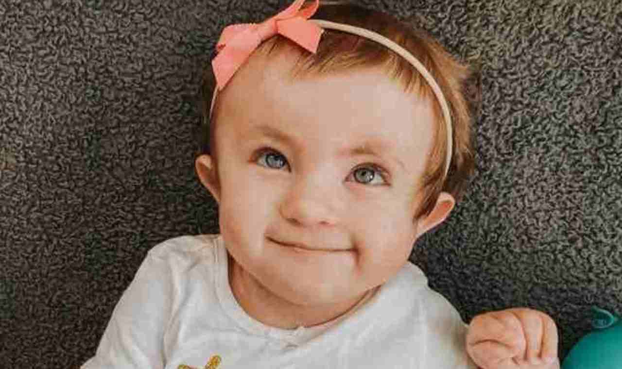 bambina con la Trisomia 18