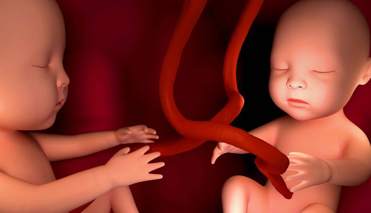 gravidanza gemellare rischi e sintomi