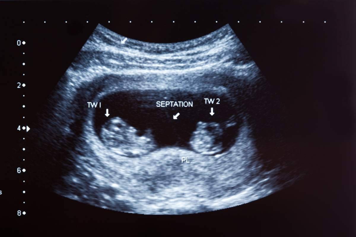 gravidanza gemellare sintomi controlli