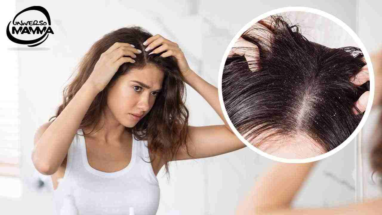 combattere la forfora