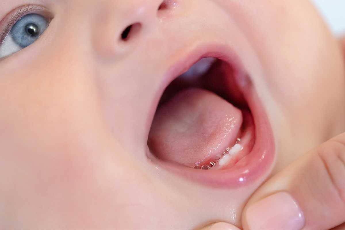 dentino bambino neonato