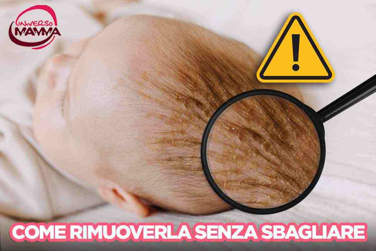 come rimuovere crosta lattea consigli