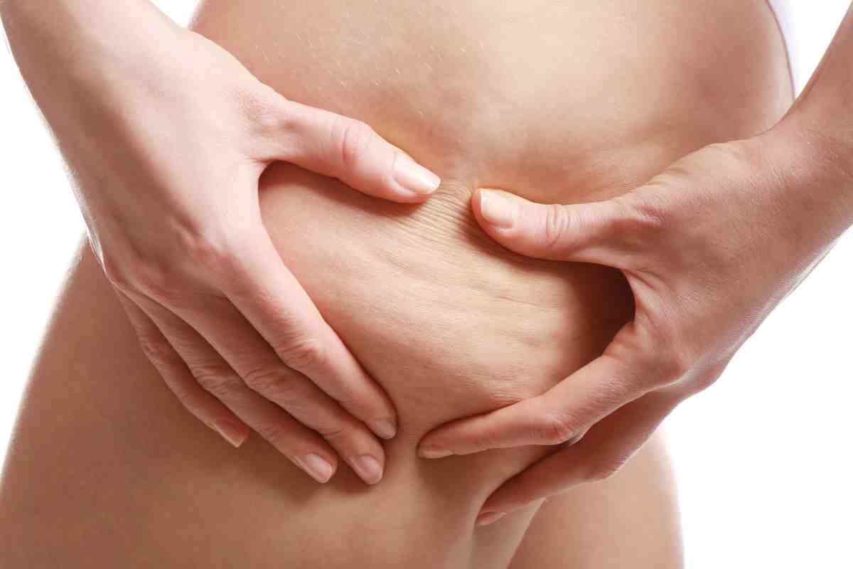 Come rimediare alla cellulite