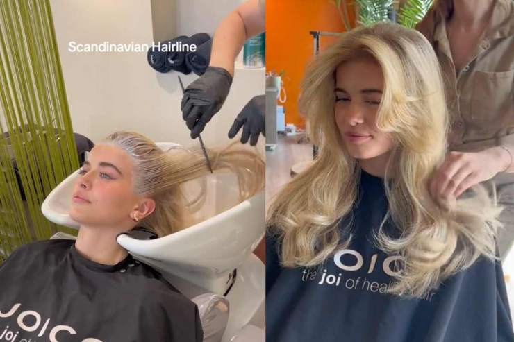 scandinavian hairline che cos'è