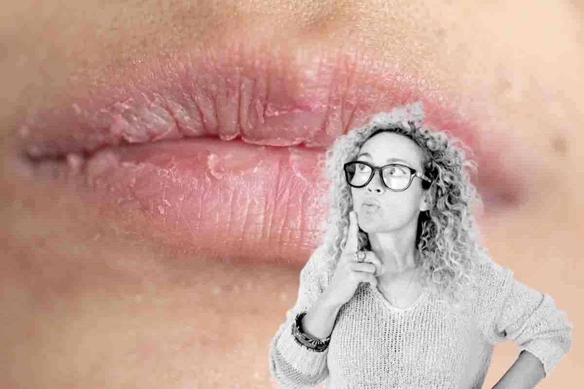 Come risolvere il problema delle labbra screpolate