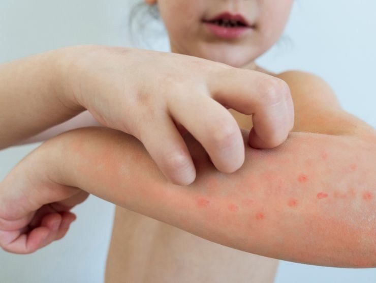 bambina che ha la varicella